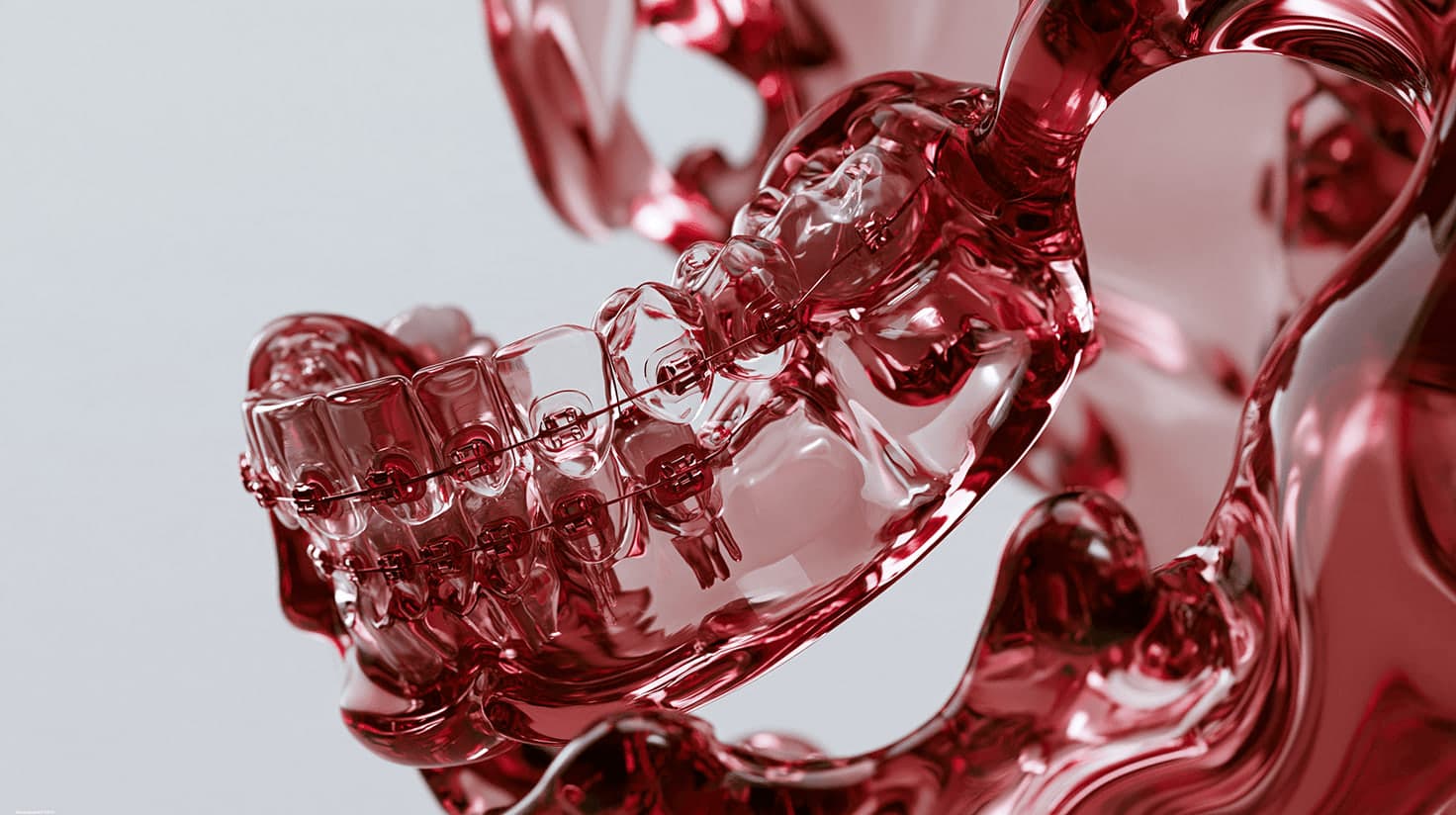 Crystal jaw arch with burgundy-toned braces
